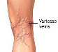Ormus Minerals Sole and varicose veins and muscles